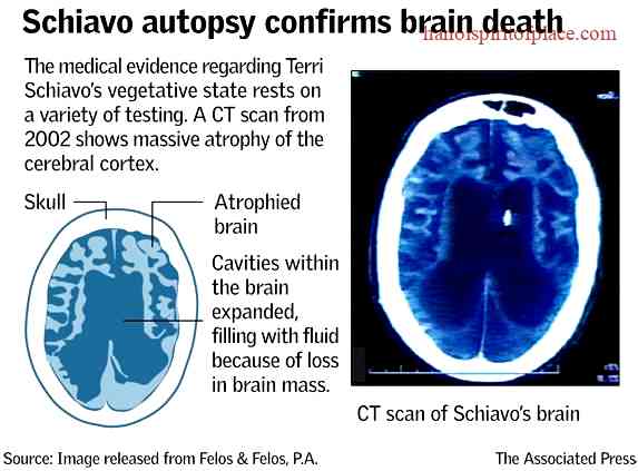 Terri Schiavo's Brain Condition