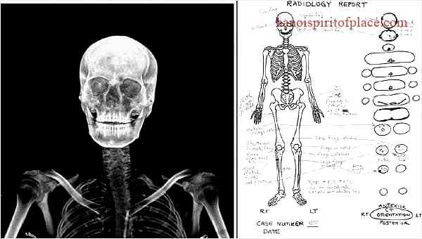 X Autopsy Photo – Unveiling the Truth Behind the Controversy