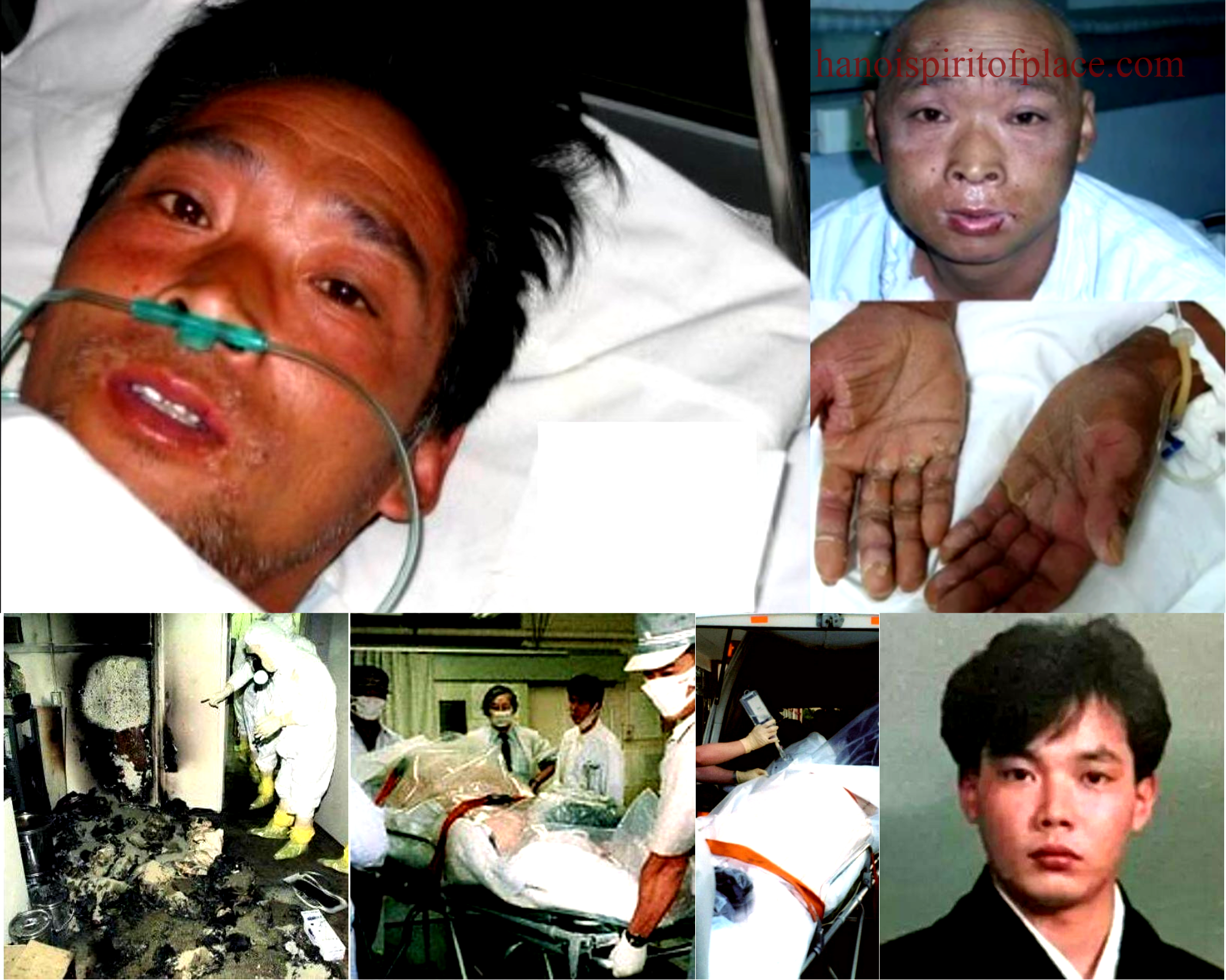 Hisashi Ouchi Real Photos Hospital: Unveiling a Tragic Medical Case