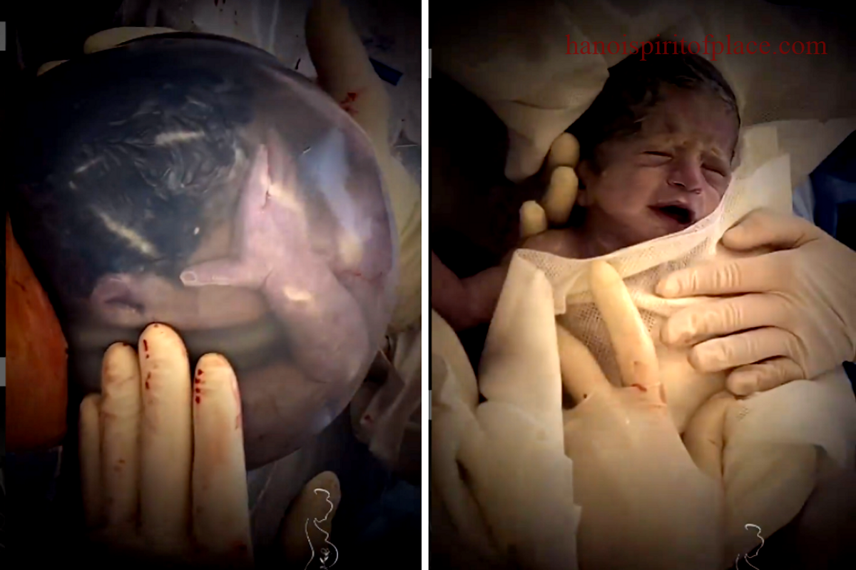 Anmniotic Sac About Infant Head Photos – Capturing Precious